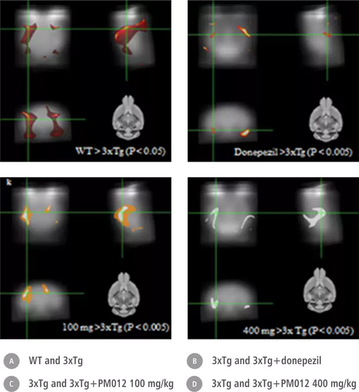 PM-012 PET Imaging Brain Glucose Metabolism